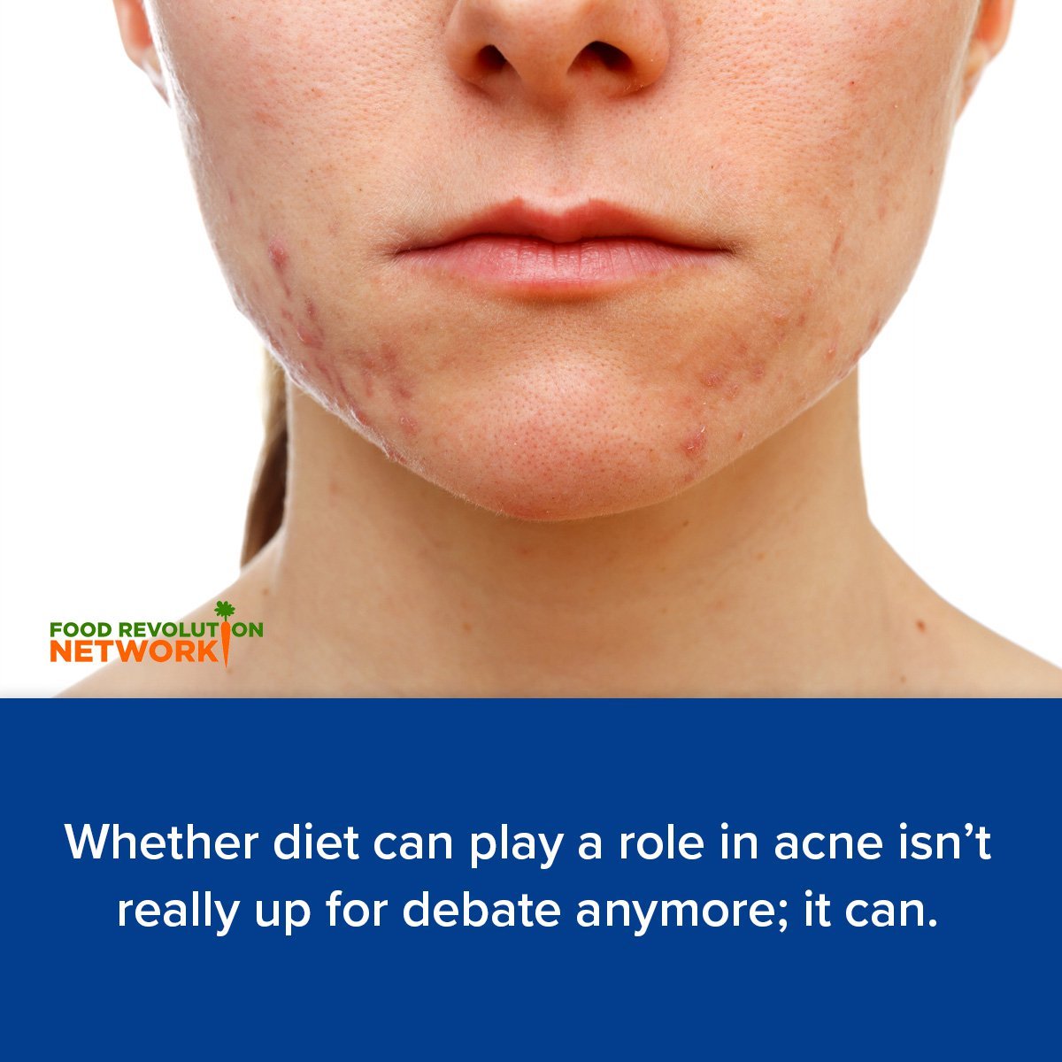 Whether diet can play a role in acne isn't really up for debate anymore; it can.