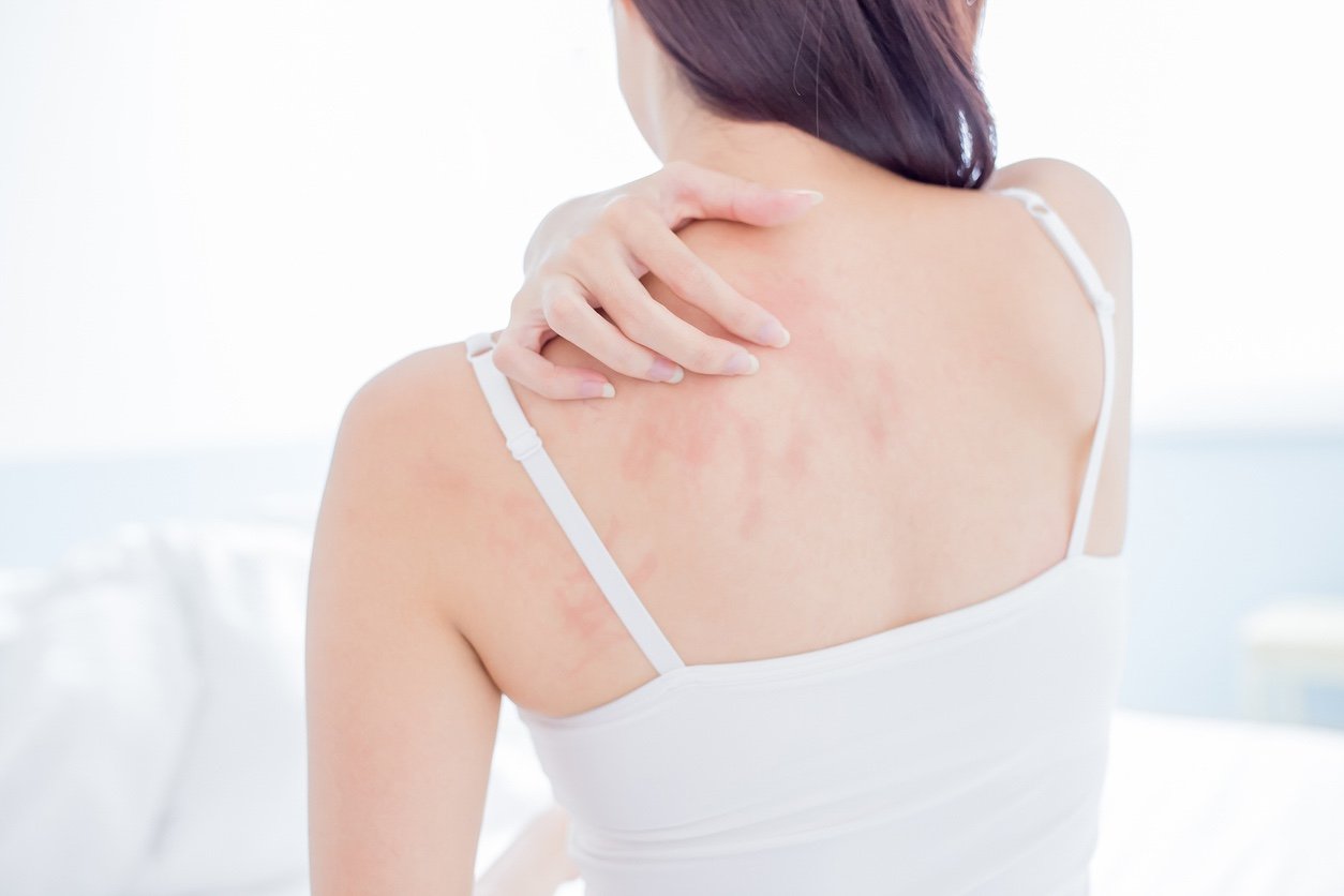 woman scratching her shoulder and neck because of dry skin at home