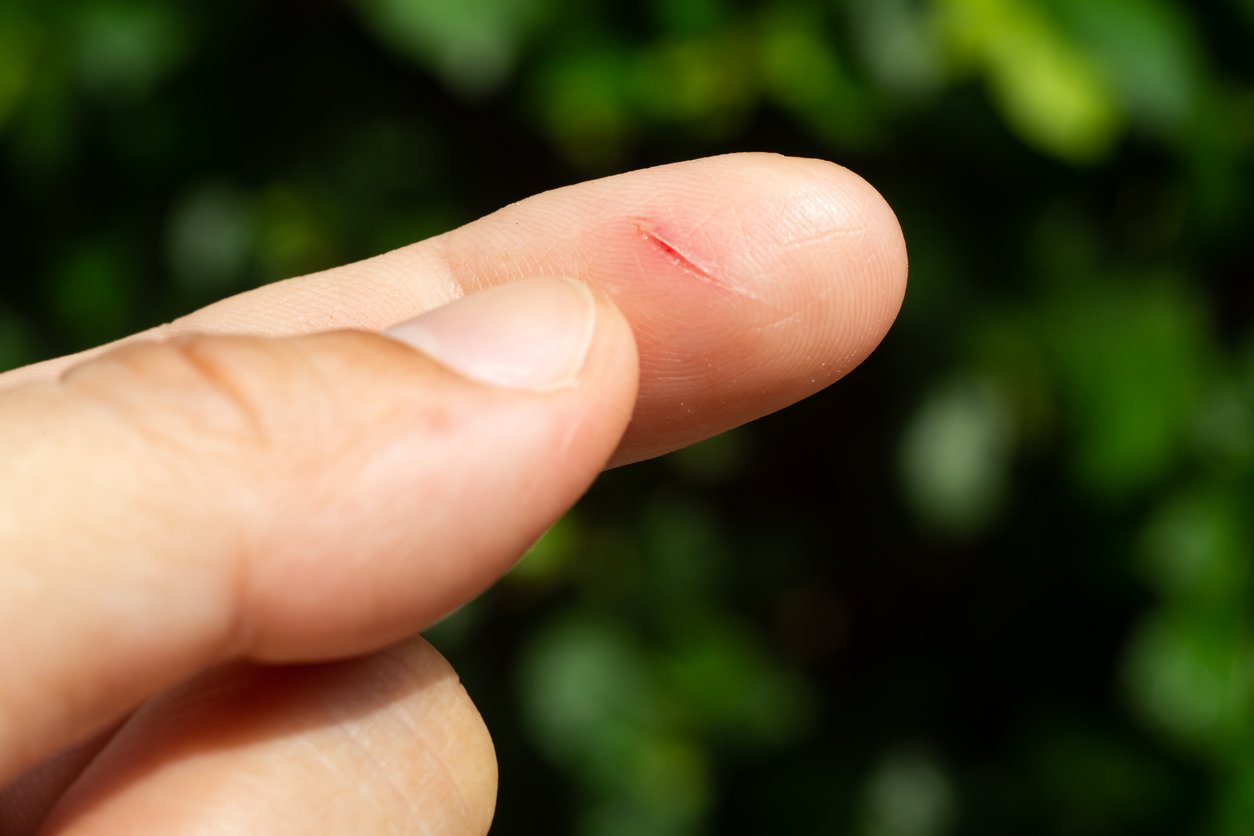 woman has been cut index finger and scar skin on hand close up macro shot asian body