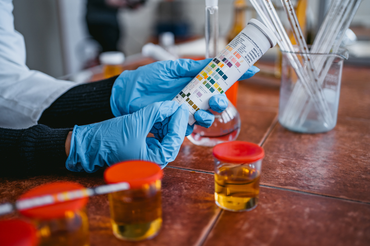 Practitioner measuring pH test strips of urine sample.