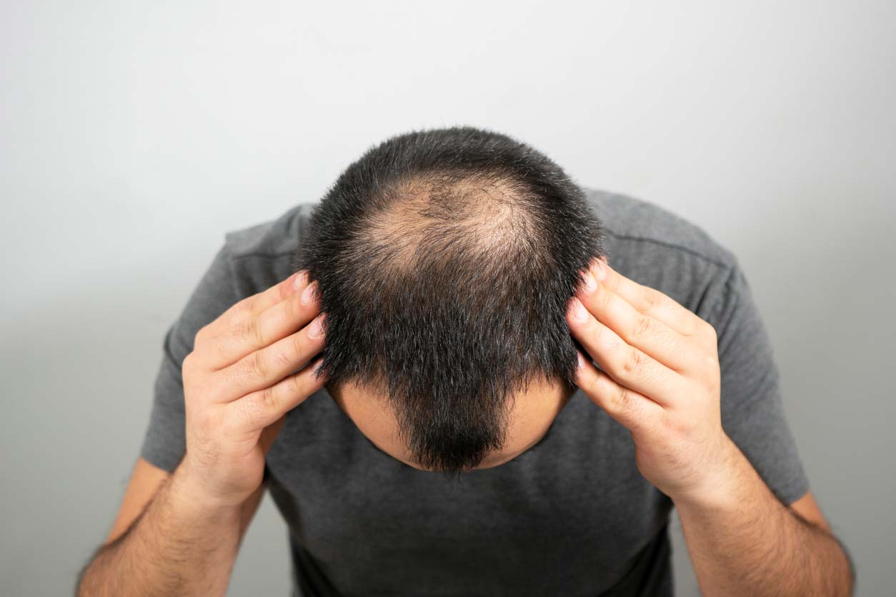 man showing sparse balding hair