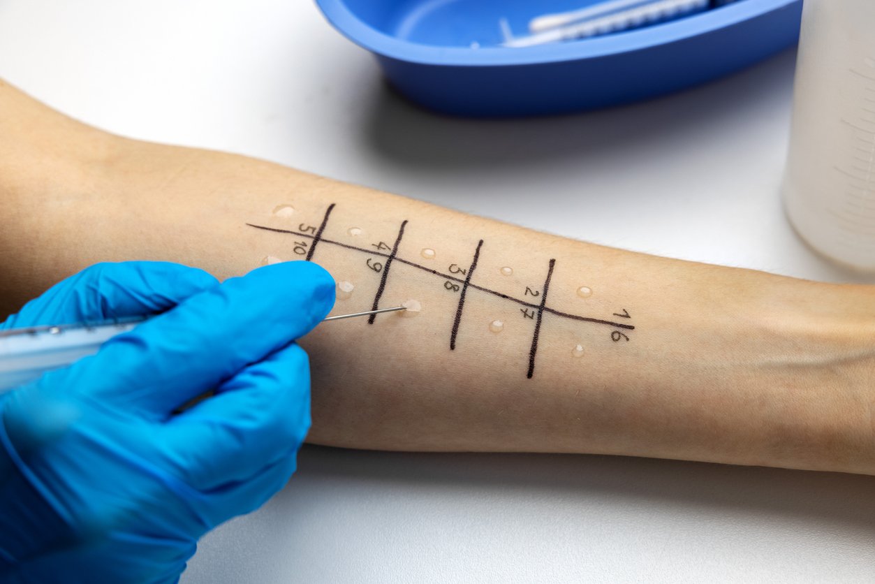 immunologist doing skin prick allergy test on a patient arm