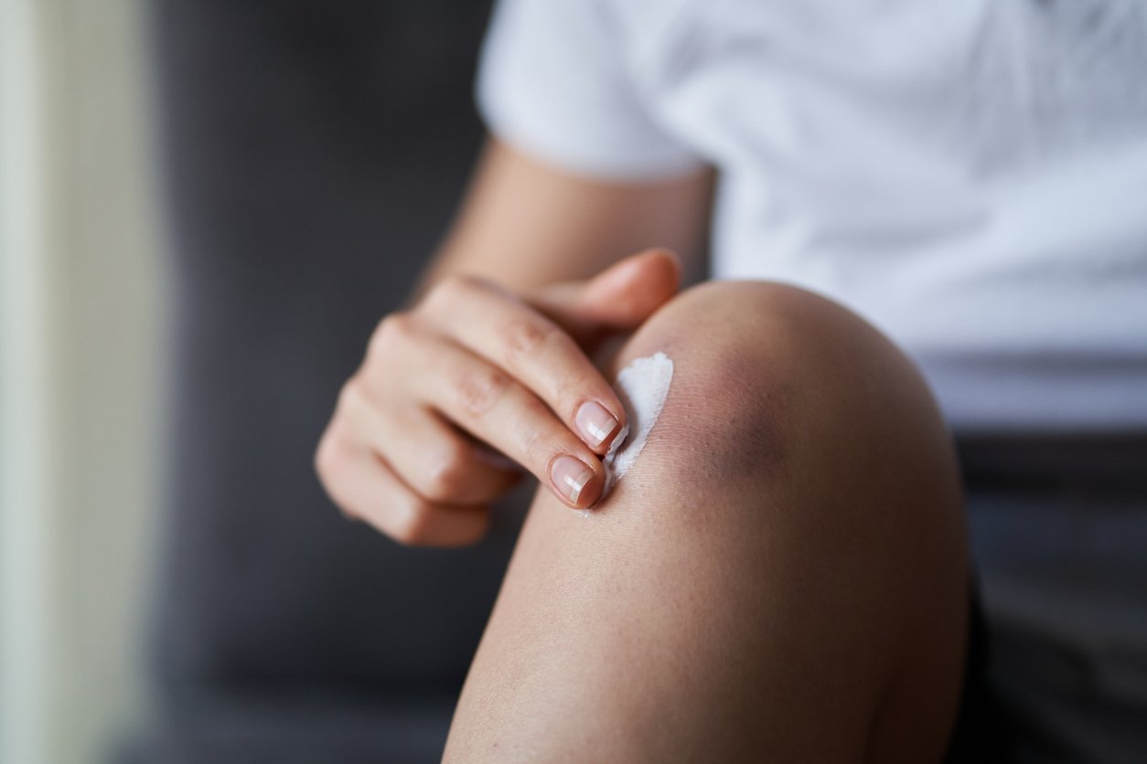 Close up of a person rubbing cream for healing injured knee joint. Bruise on the knee. Leg pain.