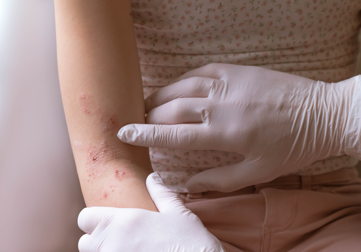 Doctor´s hand in medical gloves examining skin eczema on a child´s right arm. Girl wearing a white sleeveless top with flowers and pink pants.