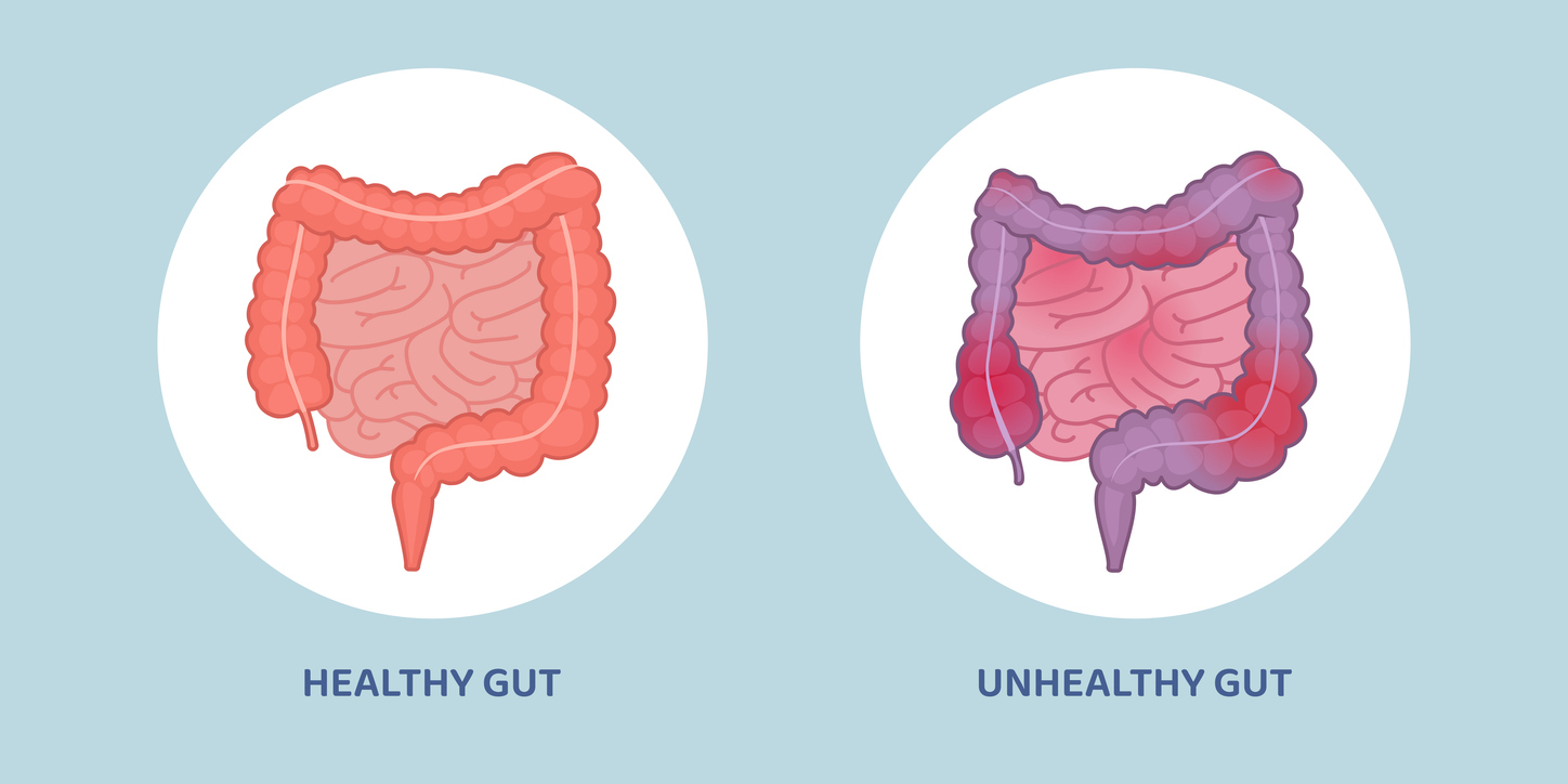 Healthy clean gut and unhealthy inflamed gut comparison