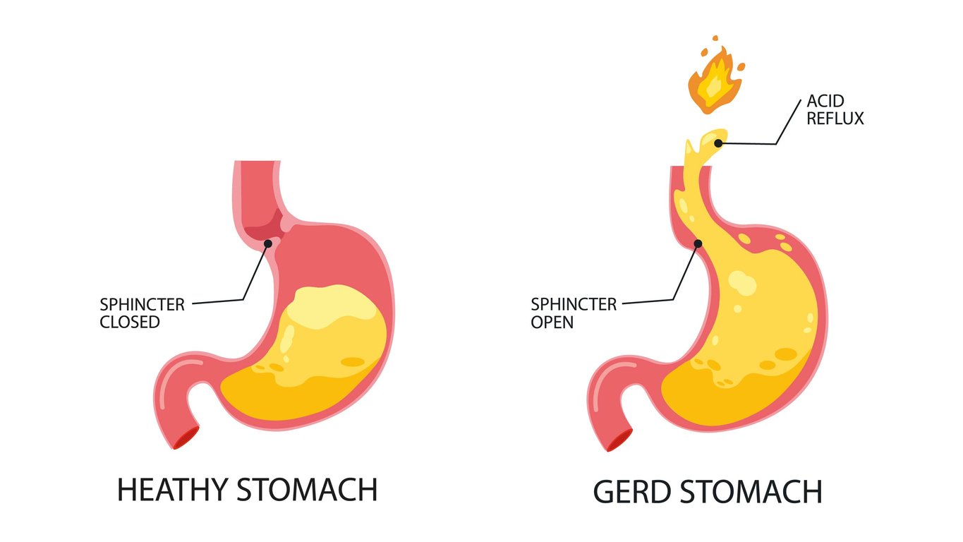 Gastroesophageal reflux disease. Infographic of normal healthy stomach and GERD stomach or heartburn. Acid moving up into the esophagus because sphincter open. Health and medicine. Flat
