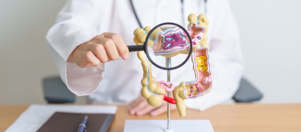 Doctor with human colon anatomy model and magnifying glass.