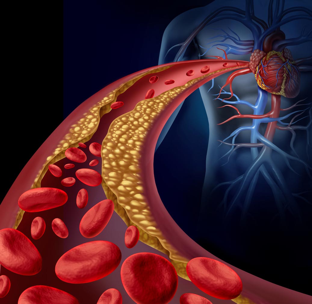 Clogged arteries from cholesterol