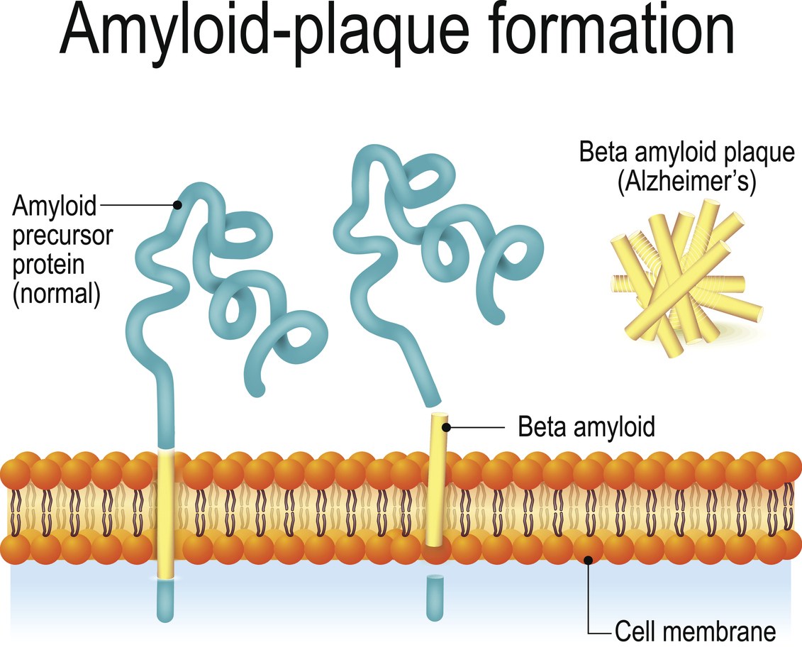 Cell membrane with Amyloid precursor protein (APP) and beta amyloid. Amyloid-plaque formation. Alzheimer's disease