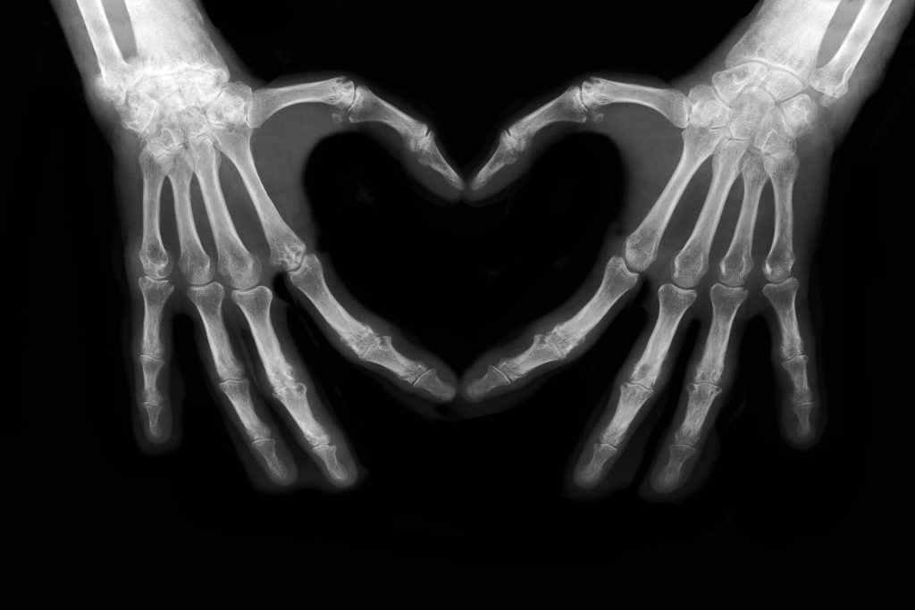X-Ray of Hands Making a Heart