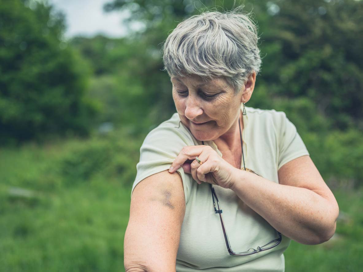 elderly woman with bruising on her arm