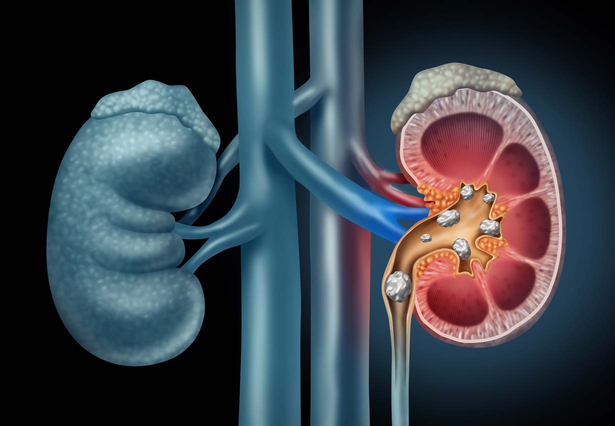 medical concept graphic of kidney stones